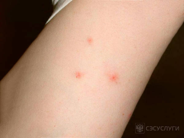 Фото укусов клещей Фото укусов клещей